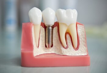 dental-implants_006