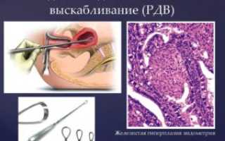 Гиперплазия эндометрия при менопаузе выскабливание отзывы