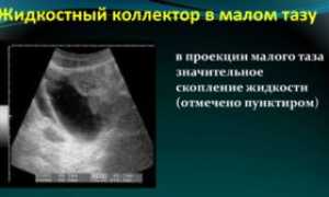 Жидкость в малом тазу что это значит у ребенка