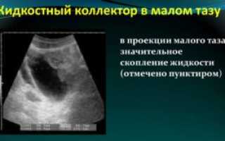 Жидкость в малом тазу что это значит у ребенка