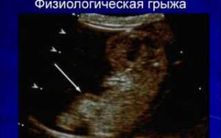 Грыжа плода 12 неделе